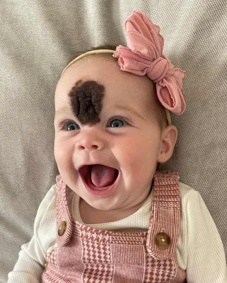 This girl had a unique birthmark and her parents decided to remove it… Here is how she looks after the surgery!