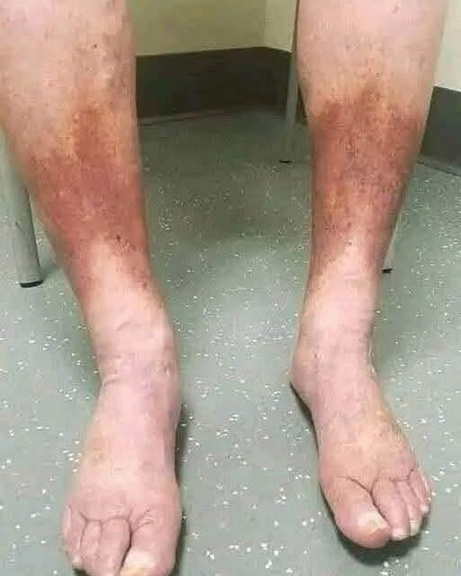 SILENT KILLER OR HARMLESS PUFFINESS? WHY YOUR SWOLLEN FEET ARE SCREAMING FOR YOUR ATTENTION