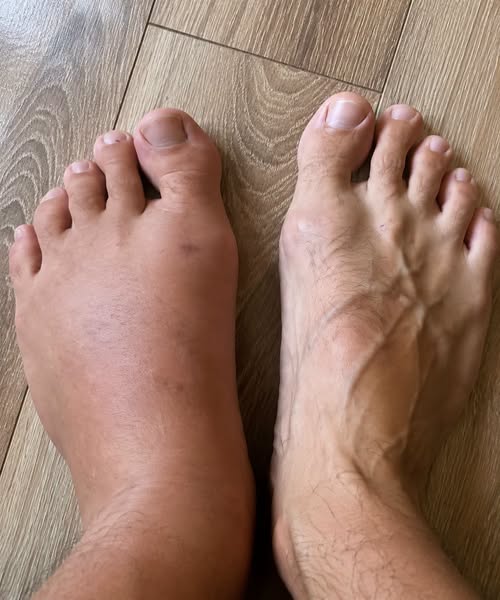 If your feet swell, it is a clear sign that…
